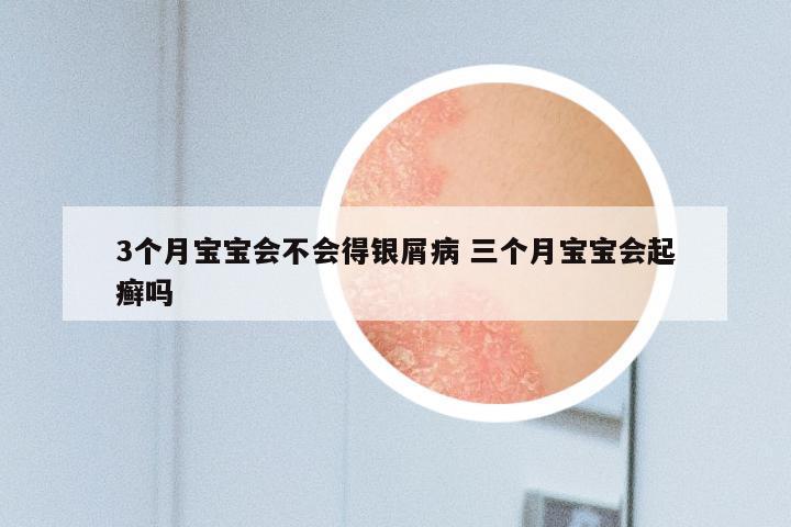3个月宝宝会不会得银屑病 三个月宝宝会起癣吗
