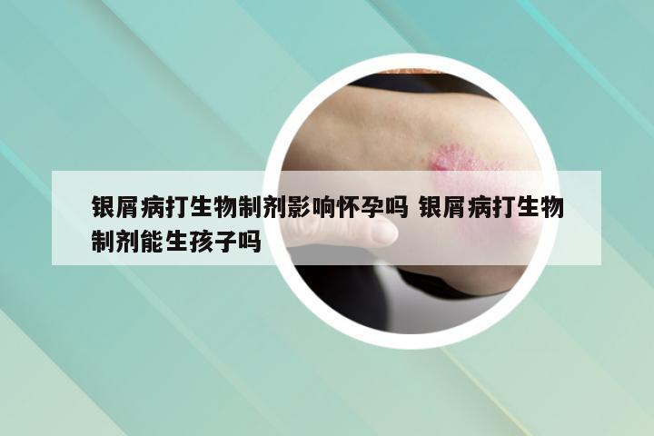 银屑病打生物制剂影响怀孕吗 银屑病打生物制剂能生孩子吗