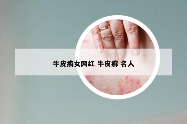 牛皮癣女网红 牛皮癣 名人