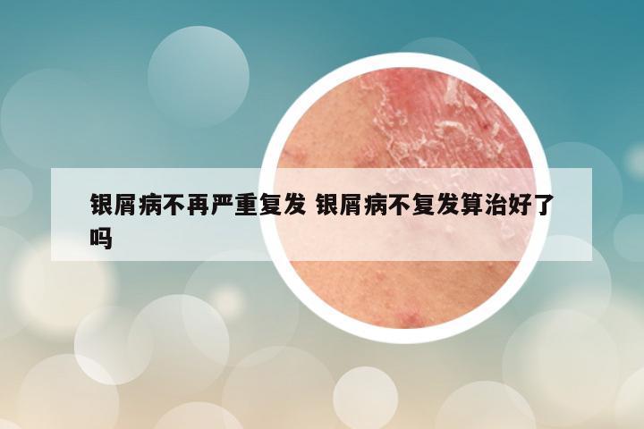 银屑病不再严重复发 银屑病不复发算治好了吗