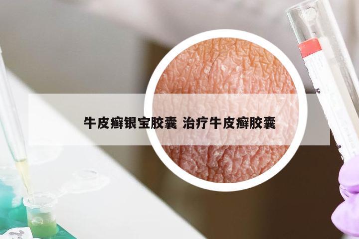 牛皮癣银宝胶囊 治疗牛皮癣胶囊