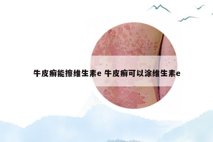 牛皮癣能擦维生素e 牛皮癣可以涂维生素e