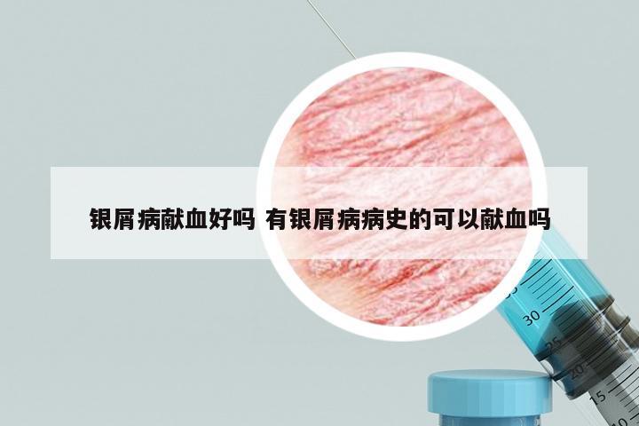 银屑病献血好吗 有银屑病病史的可以献血吗