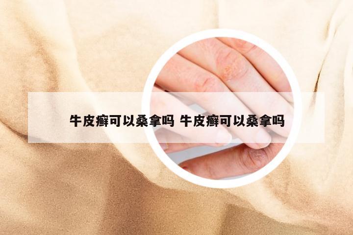牛皮癣可以桑拿吗 牛皮癣可以桑拿吗