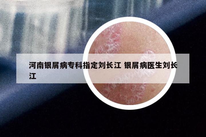 河南银屑病专科指定刘长江 银屑病医生刘长江