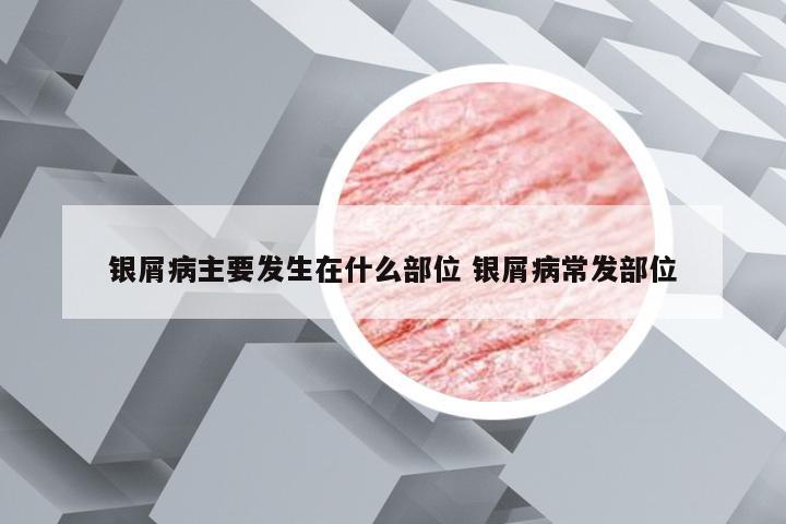 银屑病主要发生在什么部位 银屑病常发部位
