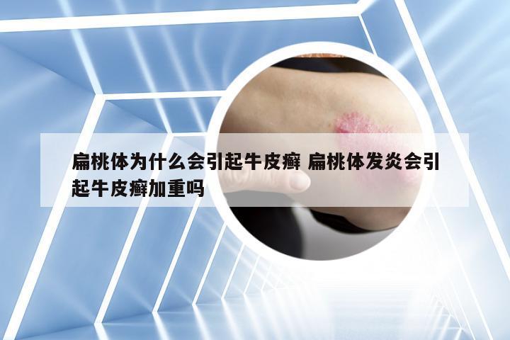 扁桃体为什么会引起牛皮癣 扁桃体发炎会引起牛皮癣加重吗