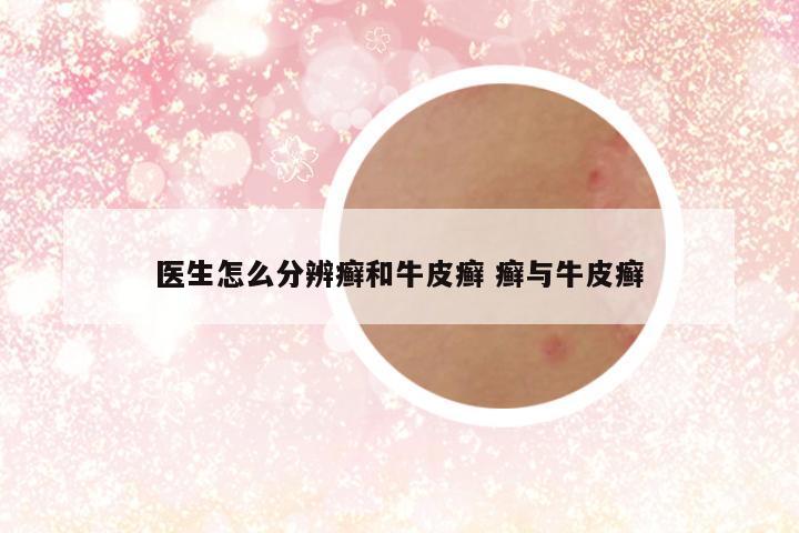 医生怎么分辨癣和牛皮癣 癣与牛皮癣