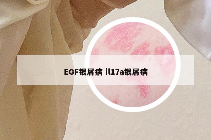 EGF银屑病 il17a银屑病