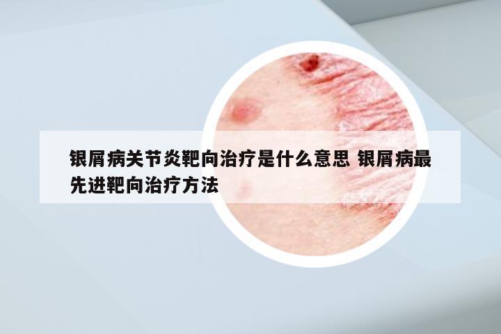 银屑病关节炎靶向治疗是什么意思 银屑病最先进靶向治疗方法