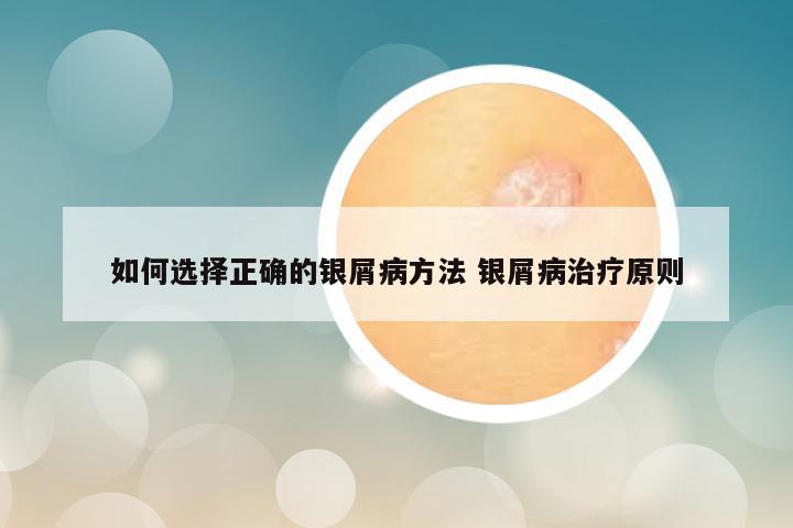 如何选择正确的银屑病方法 银屑病治疗原则