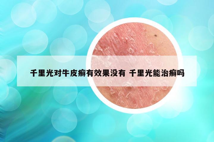千里光对牛皮癣有效果没有 千里光能治癣吗