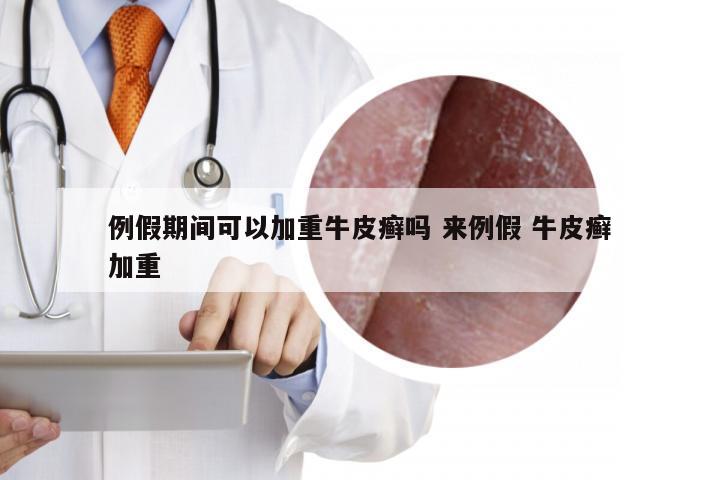 例假期间可以加重牛皮癣吗 来例假 牛皮癣加重