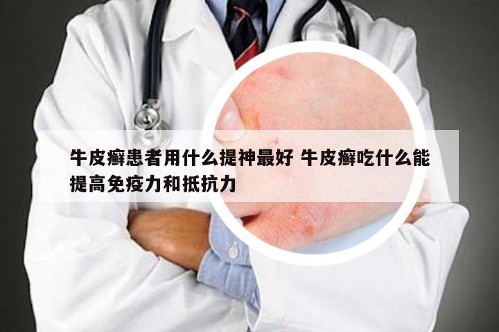 牛皮癣患者用什么提神最好 牛皮癣吃什么能提高免疫力和抵抗力