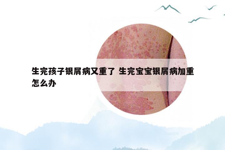生完孩子银屑病又重了 生完宝宝银屑病加重怎么办