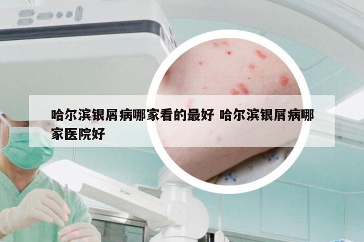 哈尔滨银屑病哪家看的最好 哈尔滨银屑病哪家医院好