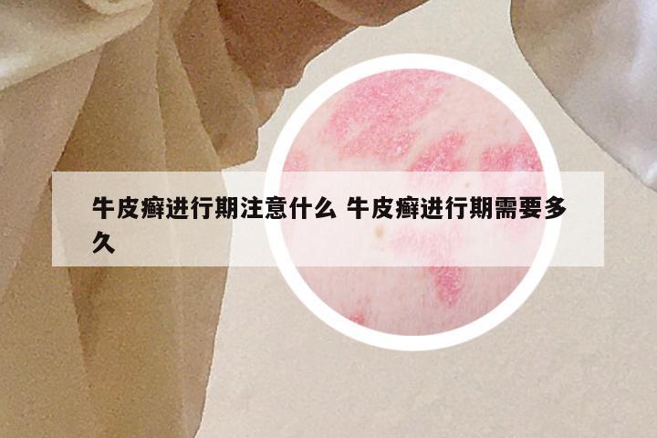 牛皮癣进行期注意什么 牛皮癣进行期需要多久