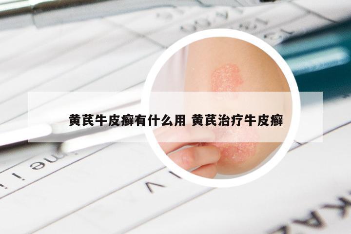 黄芪牛皮癣有什么用 黄芪治疗牛皮癣