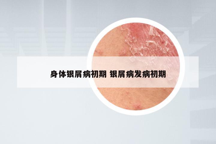 身体银屑病初期 银屑病发病初期