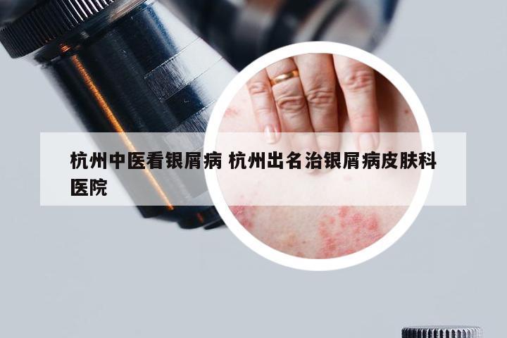 杭州中医看银屑病 杭州出名治银屑病皮肤科医院