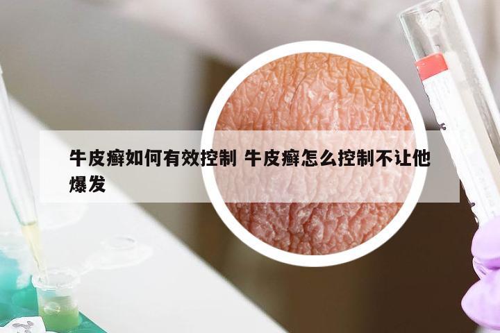 牛皮癣如何有效控制 牛皮癣怎么控制不让他爆发