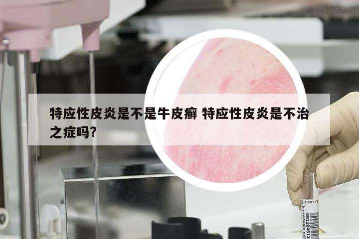 特应性皮炎是不是牛皮癣 特应性皮炎是不治之症吗?