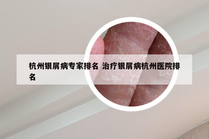 杭州银屑病专家排名 治疗银屑病杭州医院排名