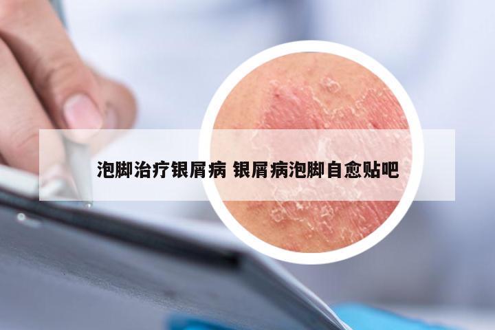 泡脚治疗银屑病 银屑病泡脚自愈贴吧