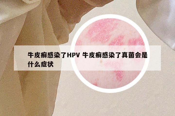 牛皮癣感染了HPV 牛皮癣感染了真菌会是什么症状