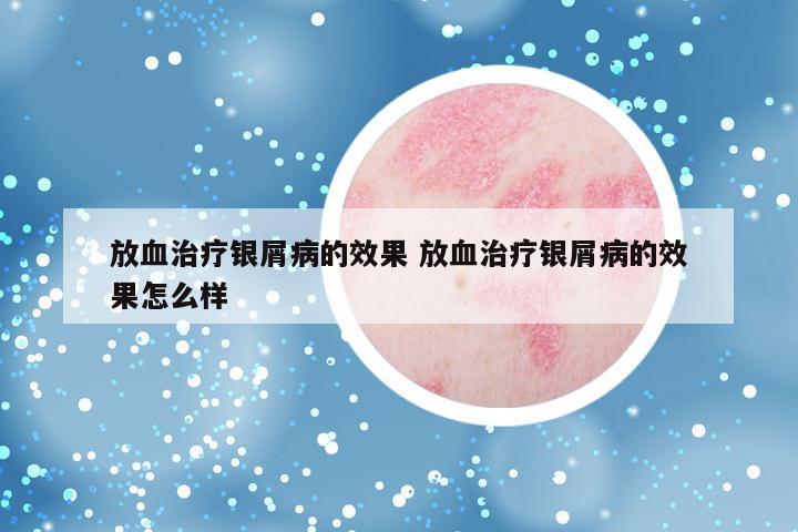 放血治疗银屑病的效果 放血治疗银屑病的效果怎么样