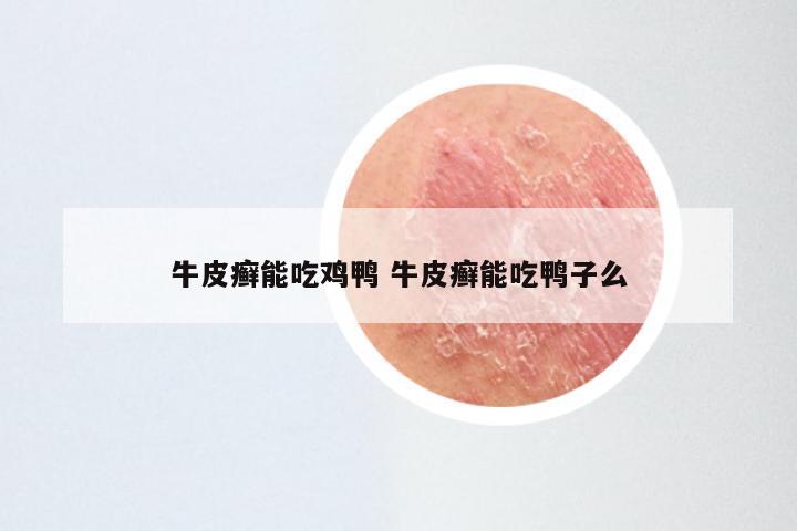 牛皮癣能吃鸡鸭 牛皮癣能吃鸭子么