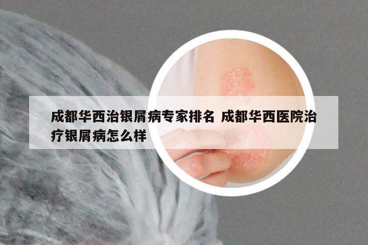 成都华西治银屑病专家排名 成都华西医院治疗银屑病怎么样