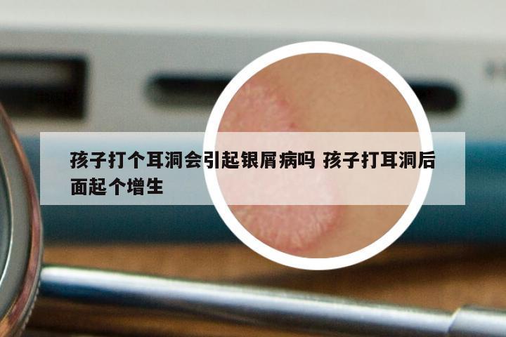 孩子打个耳洞会引起银屑病吗 孩子打耳洞后面起个增生