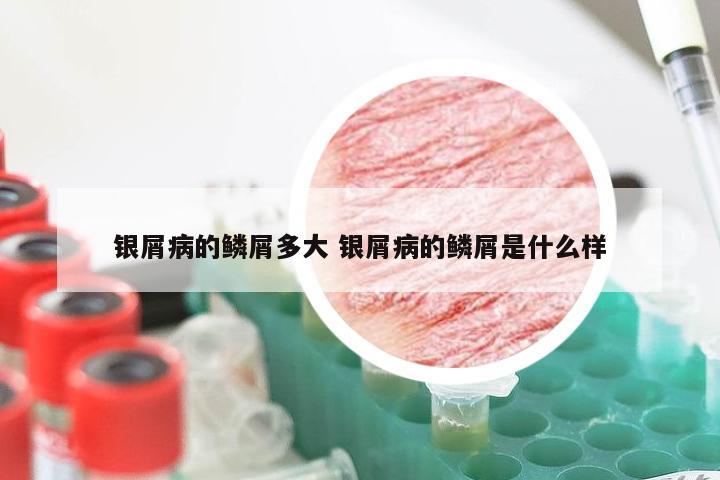 银屑病的鳞屑多大 银屑病的鳞屑是什么样