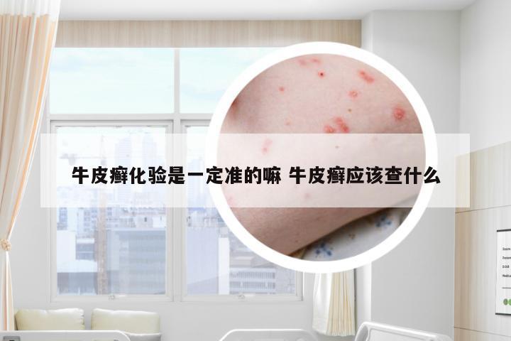 牛皮癣化验是一定准的嘛 牛皮癣应该查什么