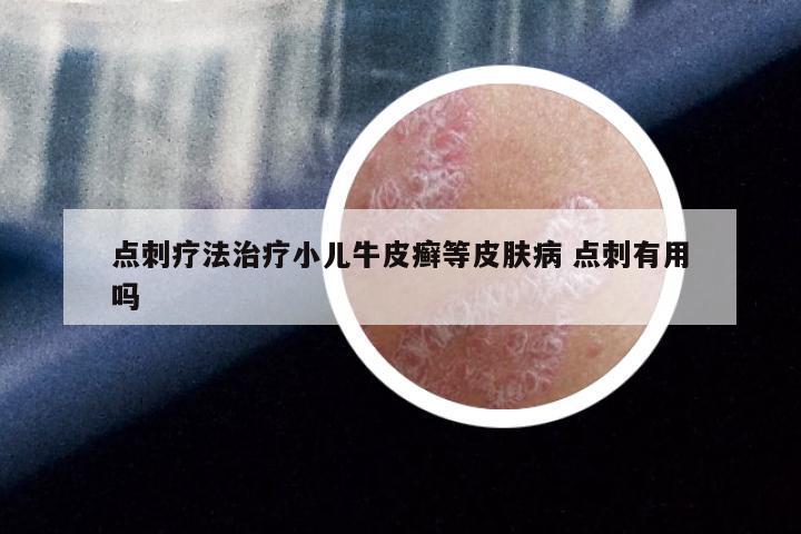 点刺疗法治疗小儿牛皮癣等皮肤病 点刺有用吗