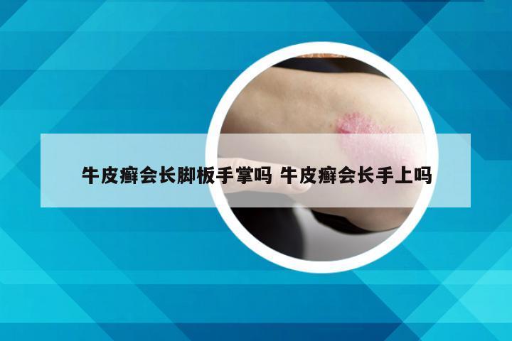 牛皮癣会长脚板手掌吗 牛皮癣会长手上吗