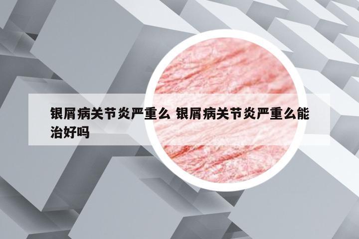 银屑病关节炎严重么 银屑病关节炎严重么能治好吗