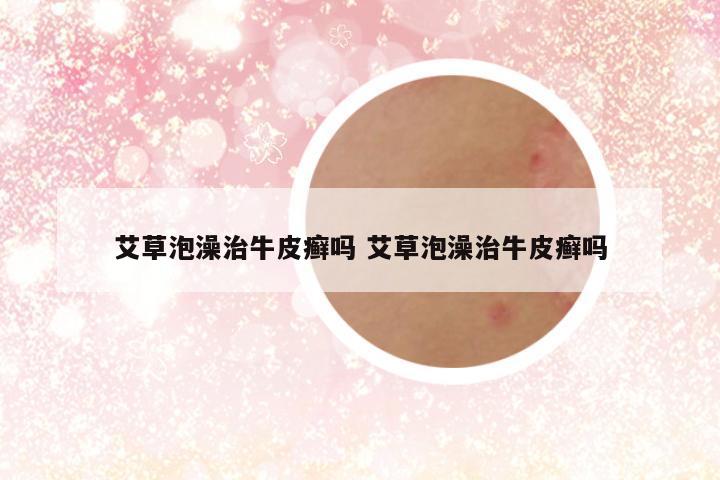 艾草泡澡治牛皮癣吗 艾草泡澡治牛皮癣吗