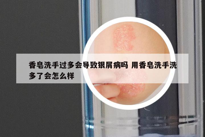 香皂洗手过多会导致银屑病吗 用香皂洗手洗多了会怎么样