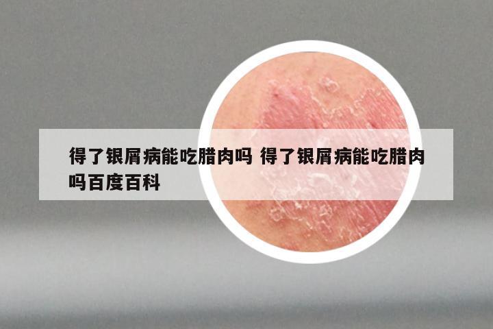 得了银屑病能吃腊肉吗 得了银屑病能吃腊肉吗百度百科