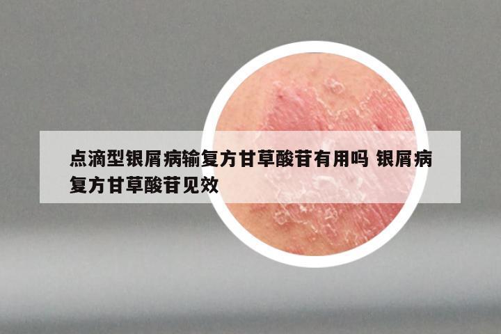 点滴型银屑病输复方甘草酸苷有用吗 银屑病复方甘草酸苷见效