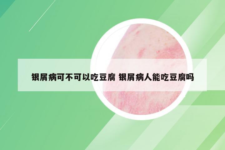 银屑病可不可以吃豆腐 银屑病人能吃豆腐吗