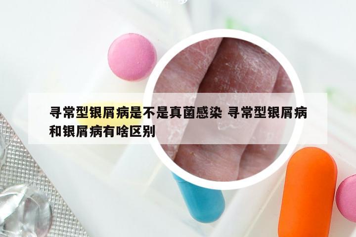 寻常型银屑病是不是真菌感染 寻常型银屑病和银屑病有啥区别