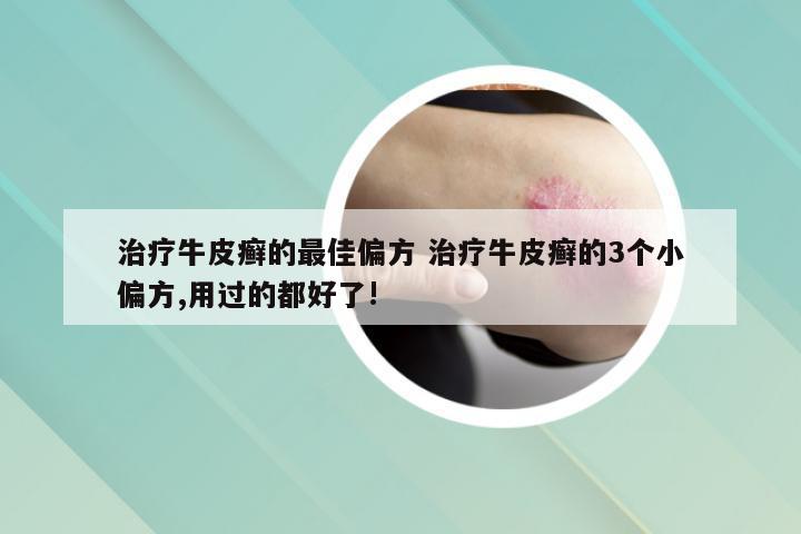 治疗牛皮癣的最佳偏方 治疗牛皮癣的3个小偏方,用过的都好了!
