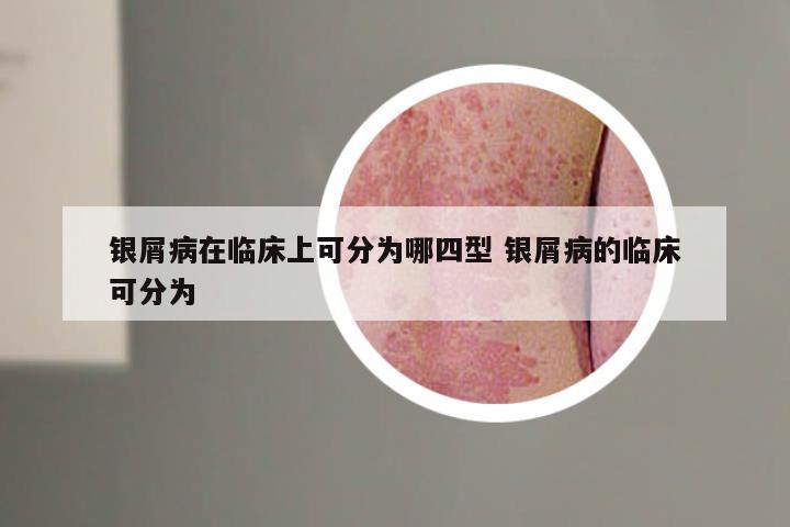 银屑病在临床上可分为哪四型 银屑病的临床可分为