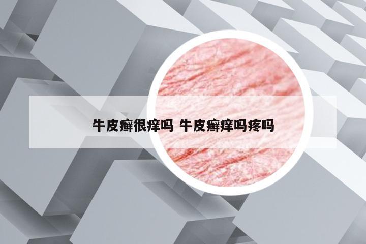 牛皮癣很痒吗 牛皮癣痒吗疼吗