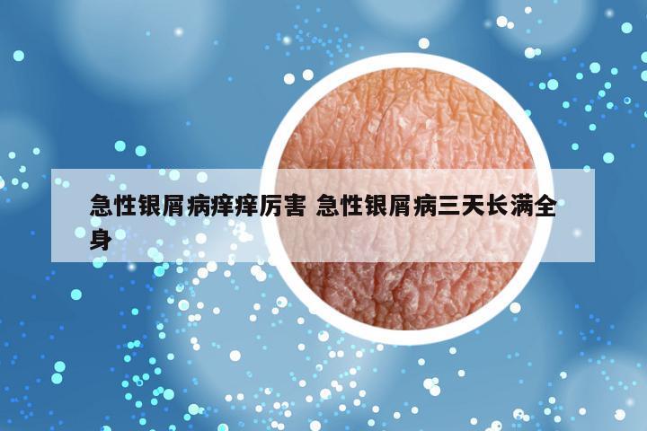 急性银屑病痒痒厉害 急性银屑病三天长满全身