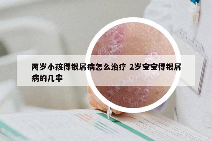 两岁小孩得银屑病怎么治疗 2岁宝宝得银屑病的几率