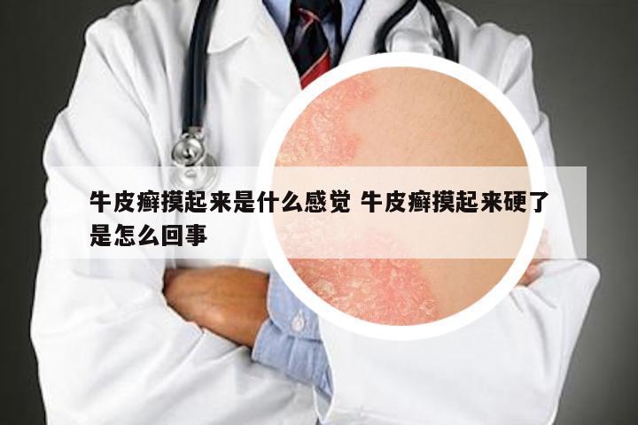牛皮癣摸起来是什么感觉 牛皮癣摸起来硬了是怎么回事